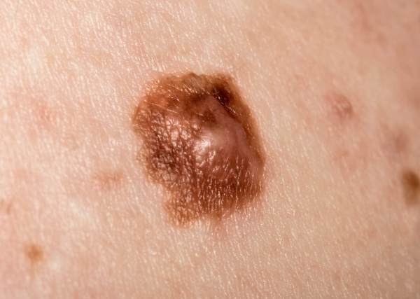 Melanooma – mitä se on ja miten voit suojautua?