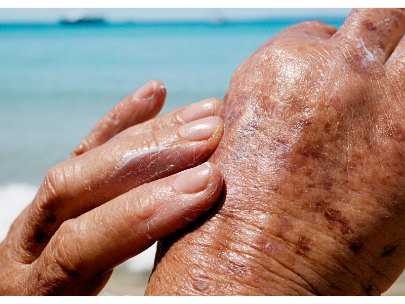 Auringon aiheuttamat ihosairaudet – miten suojaat ihon oikein?
