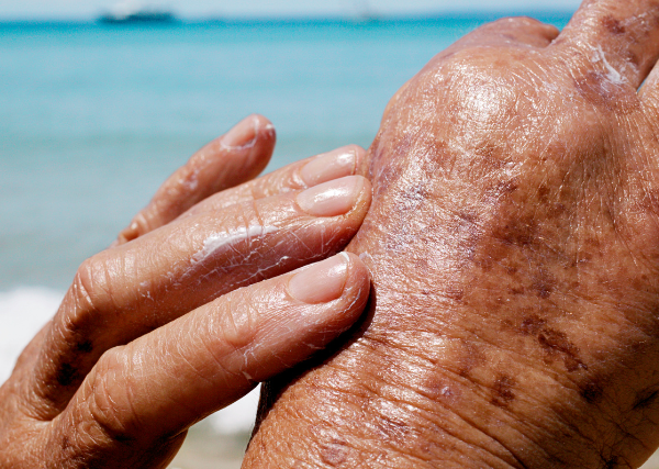 Auringon aiheuttamat ihosairaudet – miten suojaat ihon oikein?