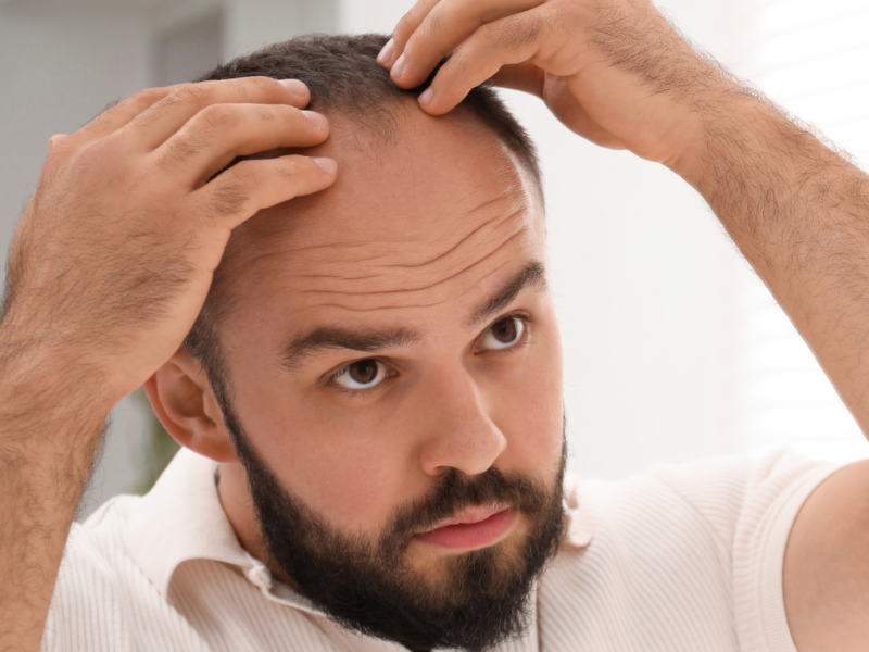 Mies, kärsitkö hiustenlähdöstä?