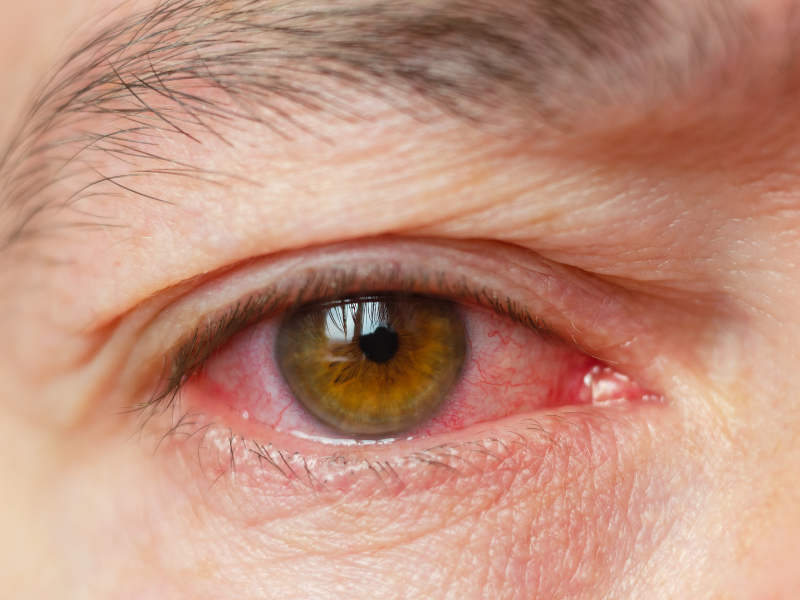 Punoittavat silm&auml;t